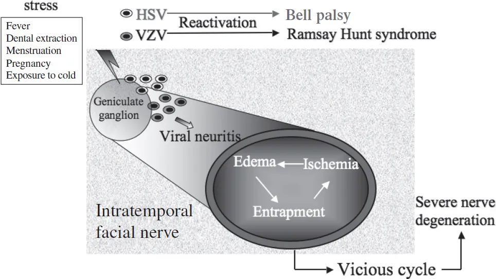 (Sumber gambar: Slattery III WH, Azizzadeh B. The Facial Nerve. Slattery III WH, Azizzadeh B, editors. Thieme. 2014;1.)